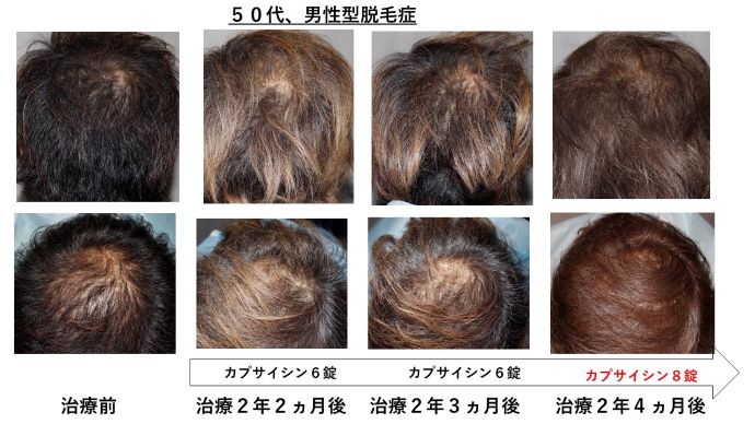 円形脱毛症　病院